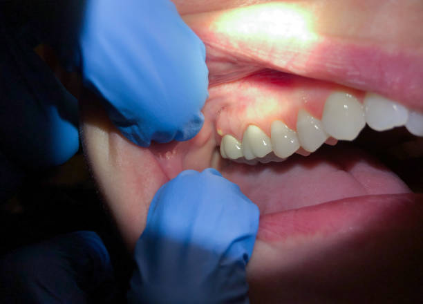 Best Knocked-Out Tooth (Avulsed Tooth) Treatment in Redland, TX