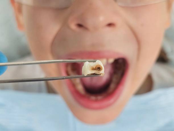 Best Emergency Wisdom Tooth Extraction in Redland, TX